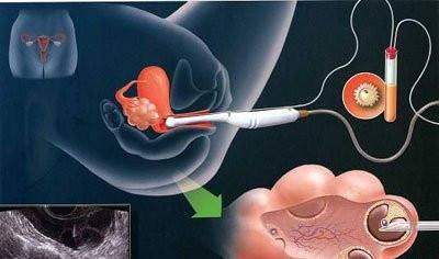 好孕案例